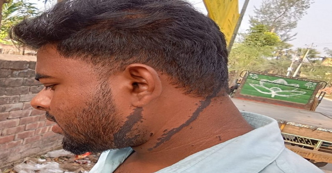 এসিড সদৃশ্য তরল পদার্থে শরীরের ছাব্বিশ দিন আগের ক্ষতের চিহৃ এখানো স্পস্ট